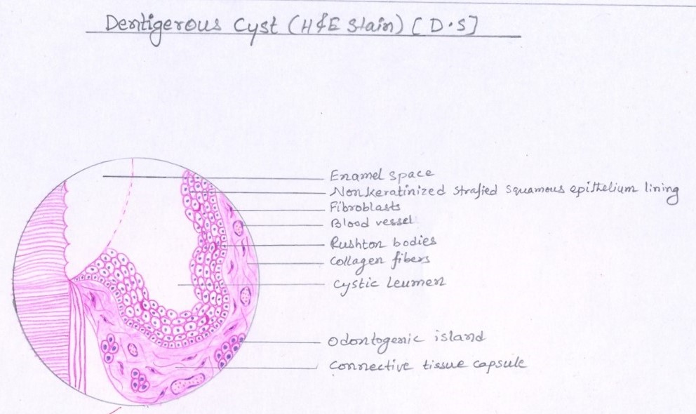 dentigerous cyst histology - dental notes