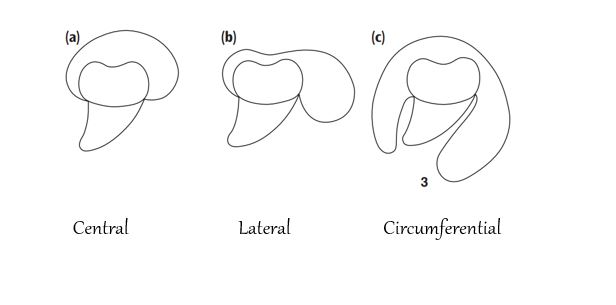 Radiographic Variants Of Dentigerous Cyst