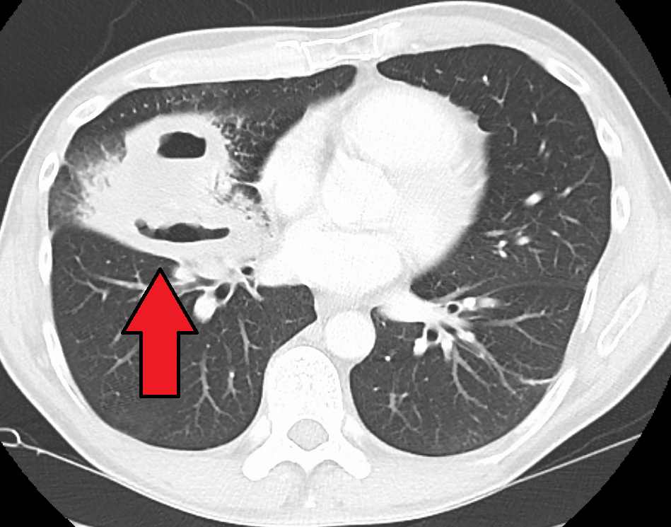 Investigations in Case of Lung abscess