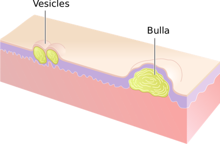 Vesicle & Bulla - skin diseases