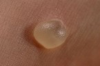 BLISTER - SKIN DISEASES