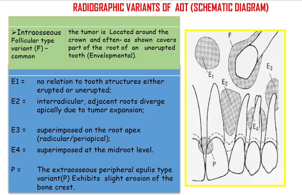 AOT Radiographic Variations