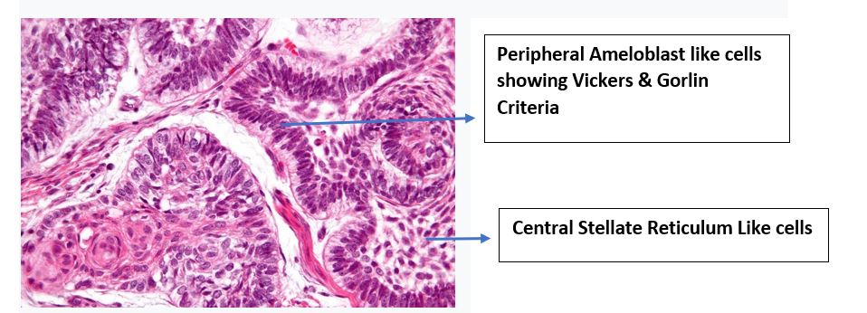 Vicker Gorlin Criteria