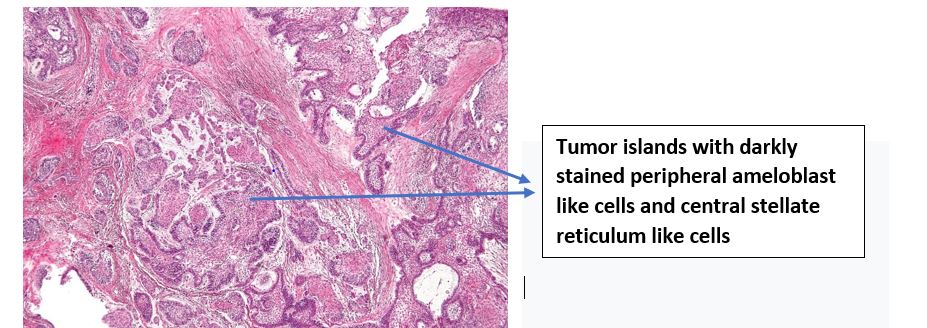 Ameloblastoma Diagram
