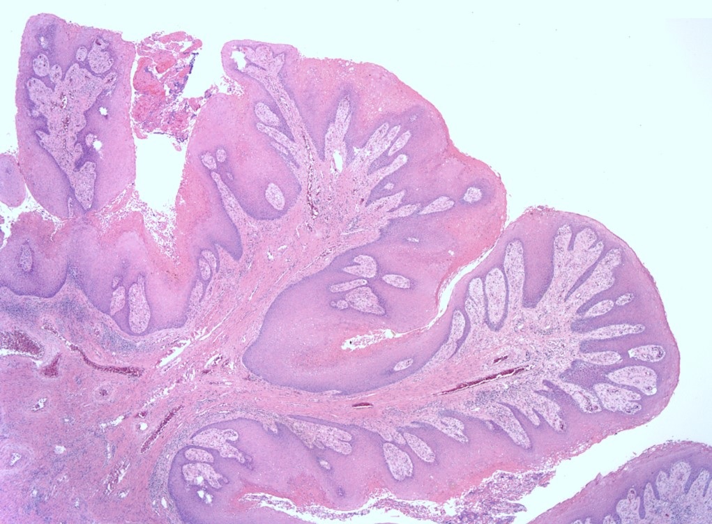 squamous papilloma oral pathology