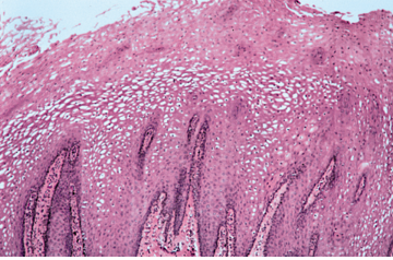 H&E stained section of leukoedema