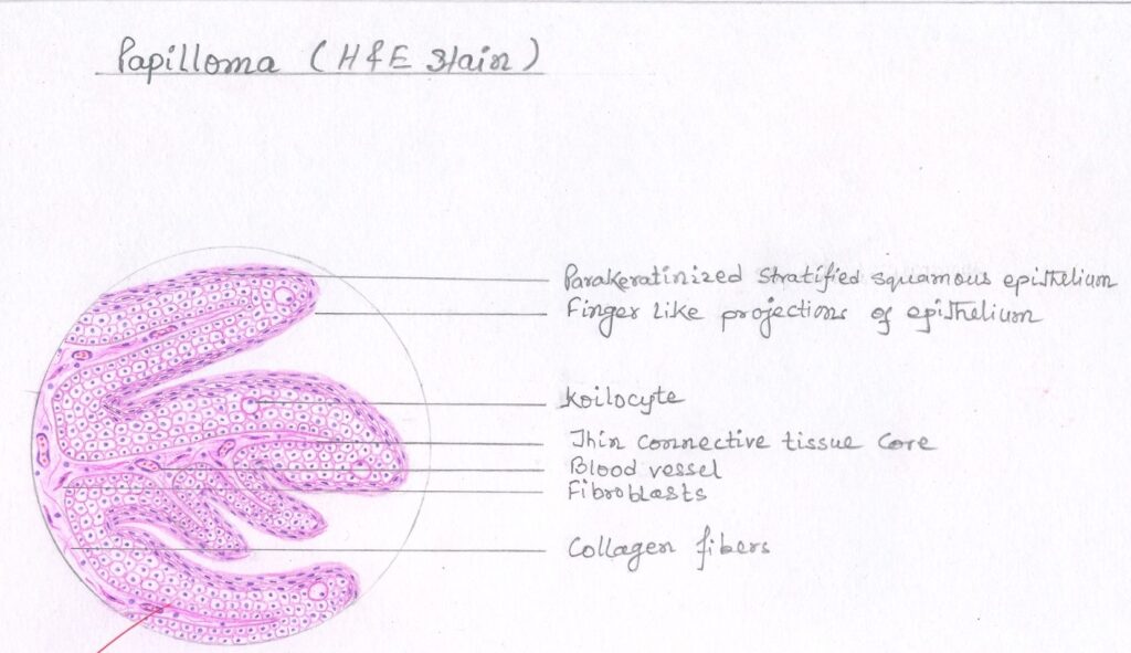 squamous papilloma histopathology diagram